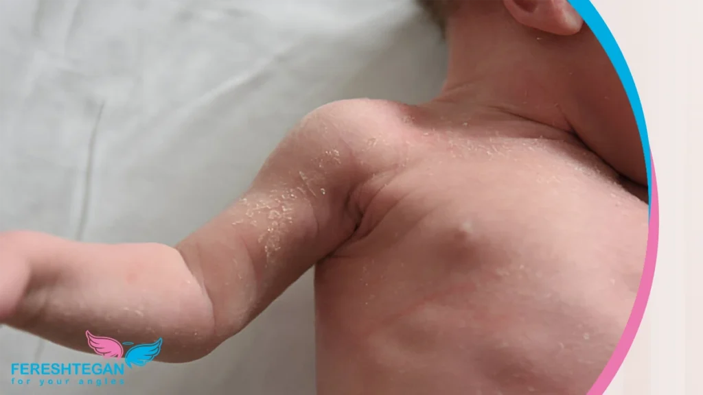 نوزادی با پوست خشک و پوستهپوستهشده، نشانهای از خشکی پوست (Xerosis) یا اگزمای نوزادی پوسته شدن پوست نوزاد( اگزمای نوزادی )