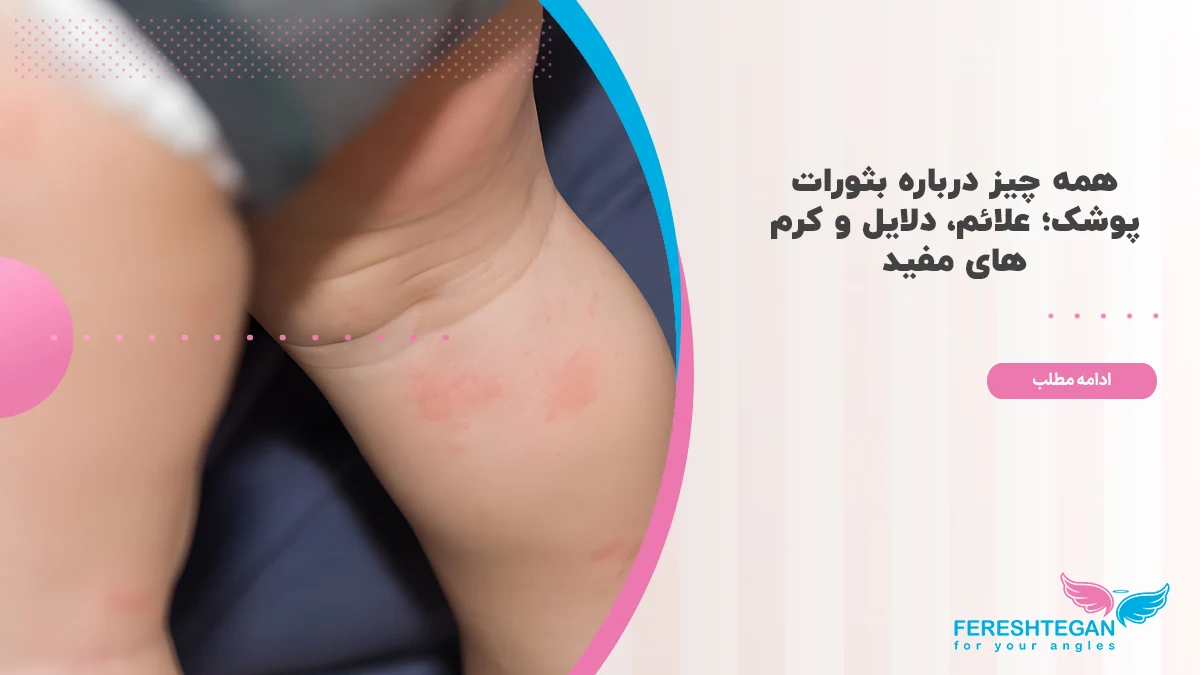 بثورات پوشک